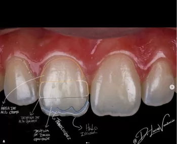 Curso de Facetas em Resina para iniciantes